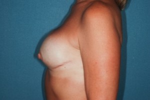 Breast Reconstrucion 1 postop lateral