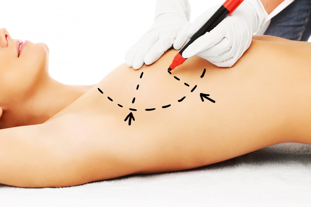 breast augmentation